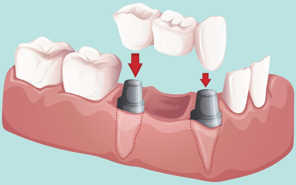 Зубные импланты в Калуге