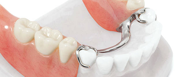 Съемное протезирование в Калуге | Протезирование зубов
