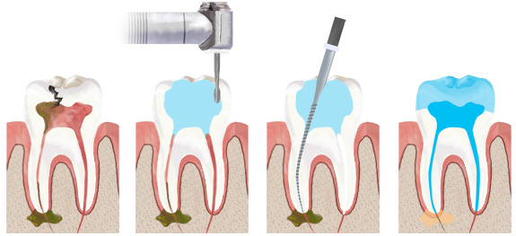 Лечение зубов удаление нерва и без Калуга