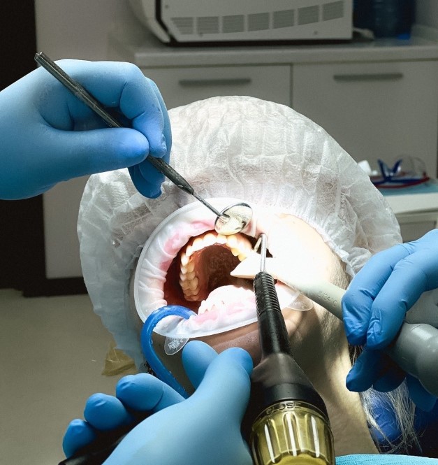 Профессиональная чистка зубов в «Эль-Дента»